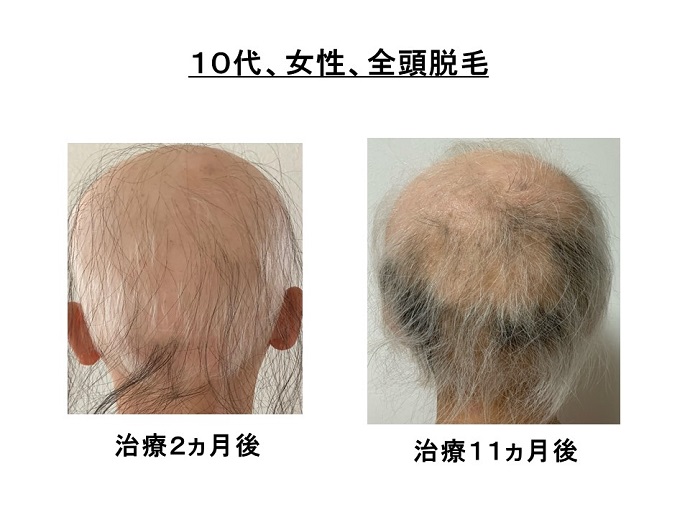 円形脱毛症　病院
